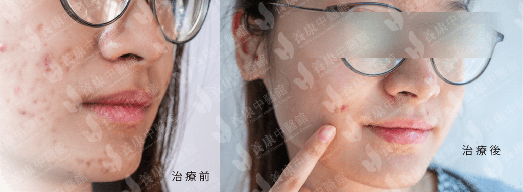 Acne Causes Treatment and Prevention